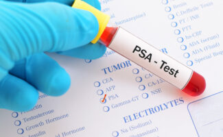 PSA en el Cáncer de Próstata: Guía Completa sobre el Antígeno Prostático Específico y su Importancia en la Detección